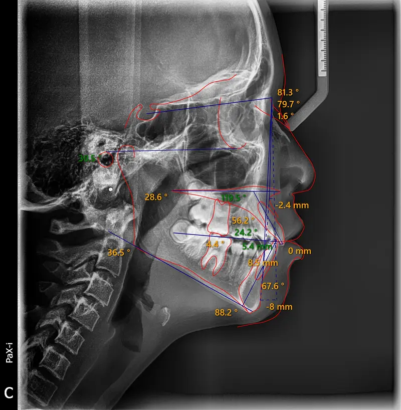 Cephalometric tracing