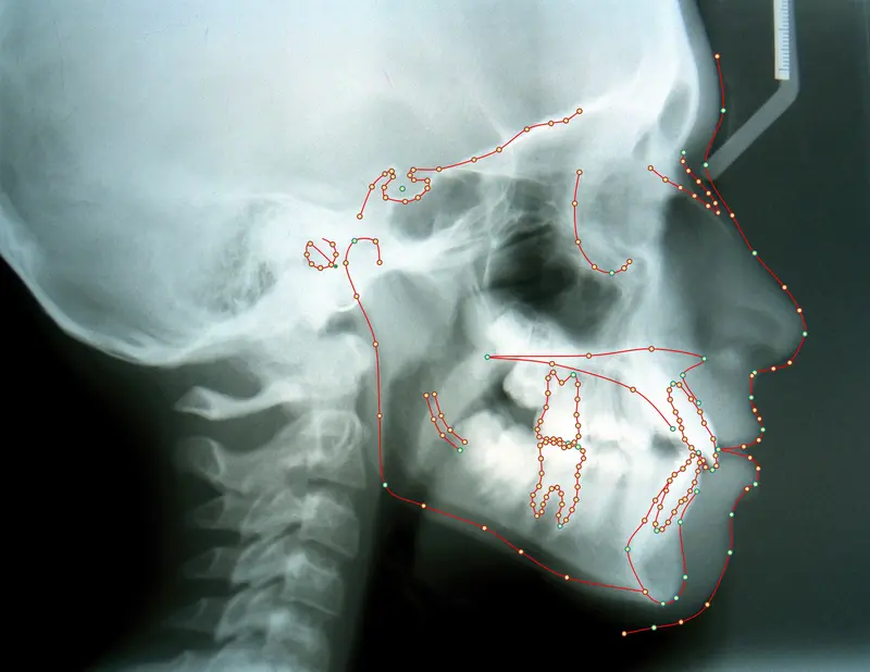 Cephalometric tracing