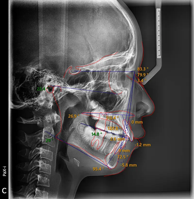 Cephalometric tracing