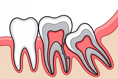 Illustration of Ectopic Eruption