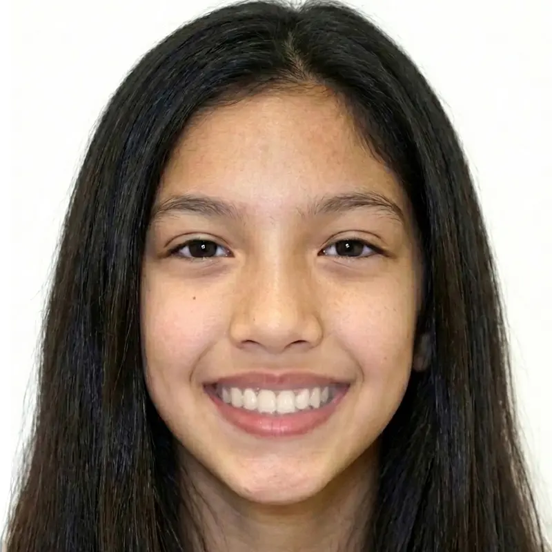 After treatment: The Non-Extraction Arc