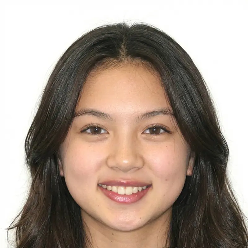 After treatment: Crossbite & Smile Arc