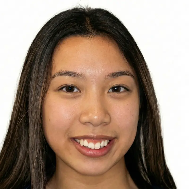 Before treatment: Vertical Control & Intrusion