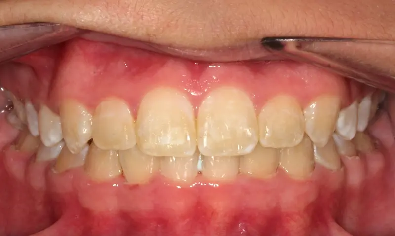 After treatment: Intraoral Occlusal Comparison