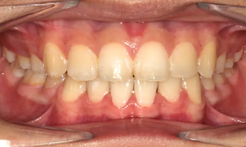 After treatment: Intraoral Occlusal Comparison
