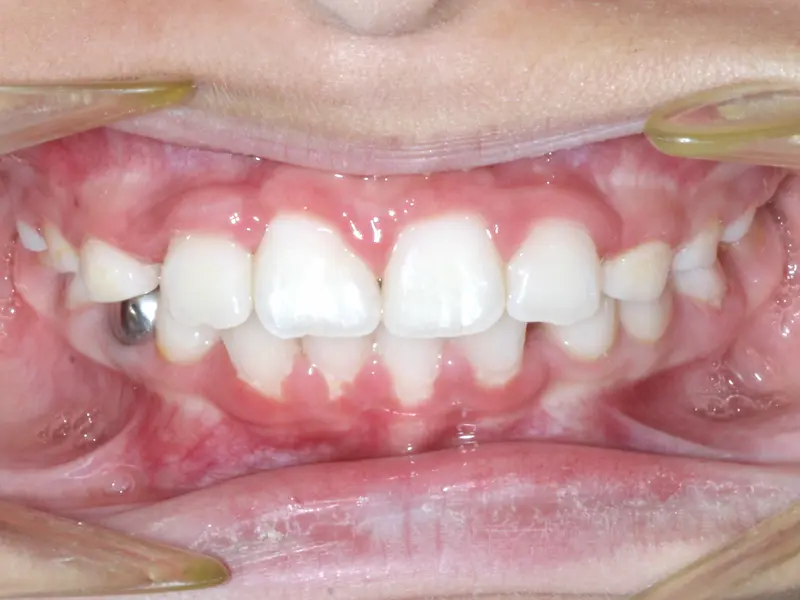 After treatment: Intraoral Occlusal Comparison