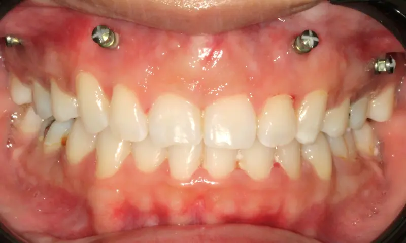 After treatment: Intraoral Occlusal Comparison