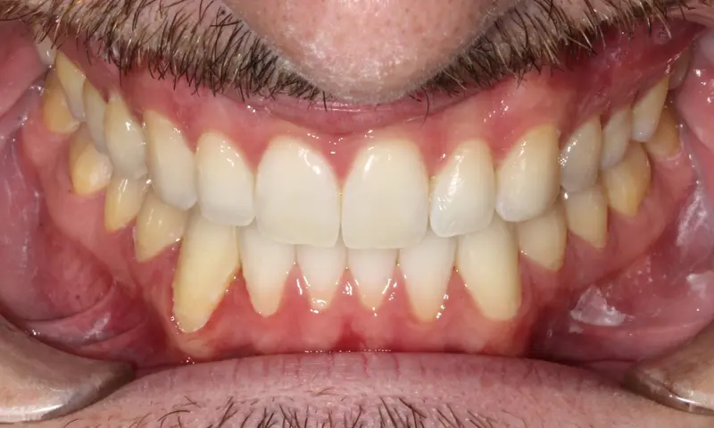After treatment: Intraoral Occlusal Comparison