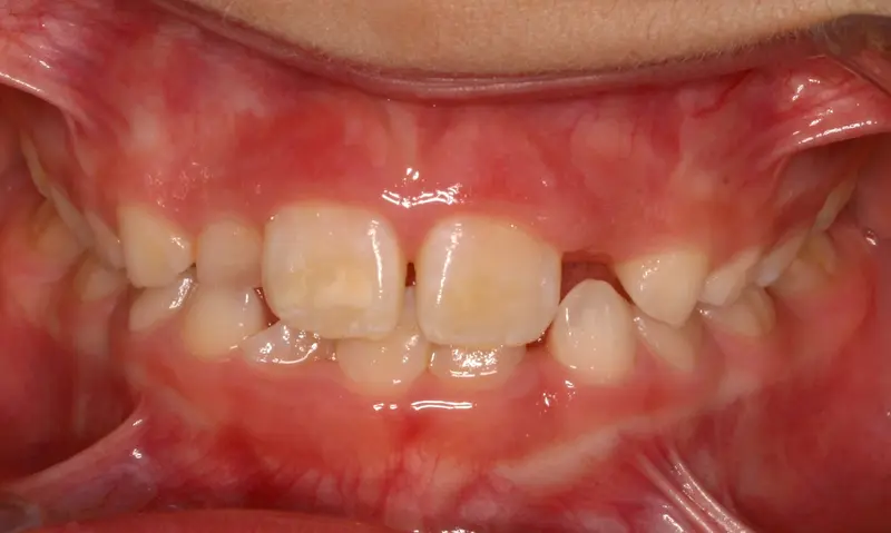 Before treatment: Intraoral Occlusal Comparison