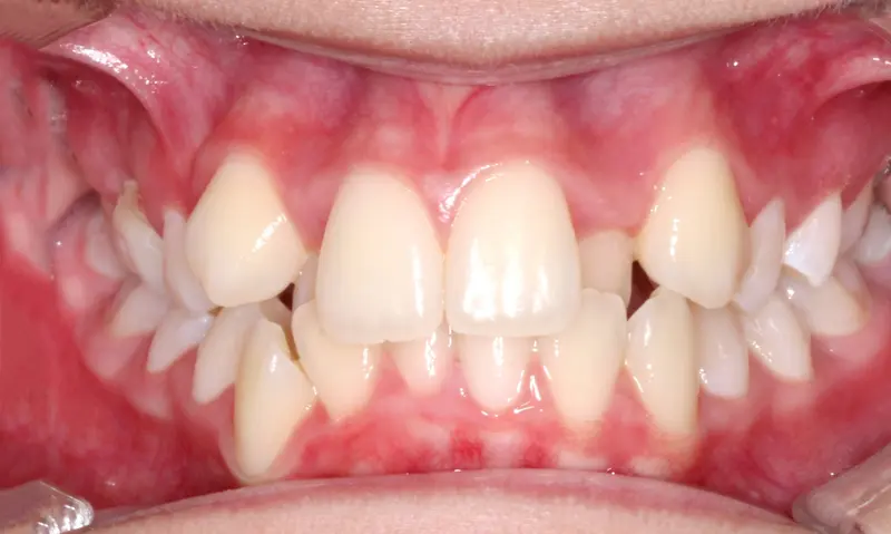 Before treatment: Intraoral Occlusal Comparison
