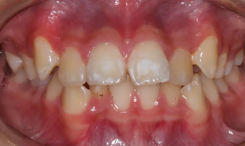 Before treatment: Intraoral Occlusal Comparison
