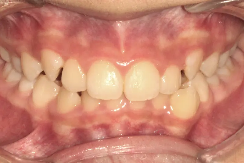 Before treatment: Intraoral Occlusal Comparison