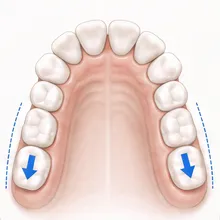 Clinical illustration of molars moving backward into posterior space.
