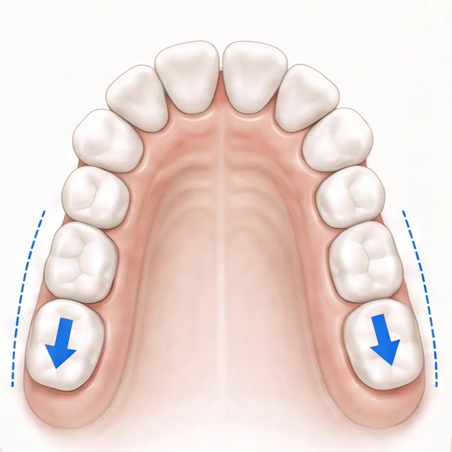 Clinical illustration of molars moving backward into posterior space.