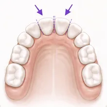 Clinical illustration of tiny enamel-width changes between front teeth.
