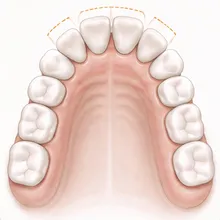 Clinical illustration of front teeth tipping forward with orange guide lines.