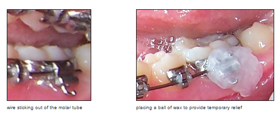 Info About Braces Problems & Orthodontic Emergencies - Irvine, CA
