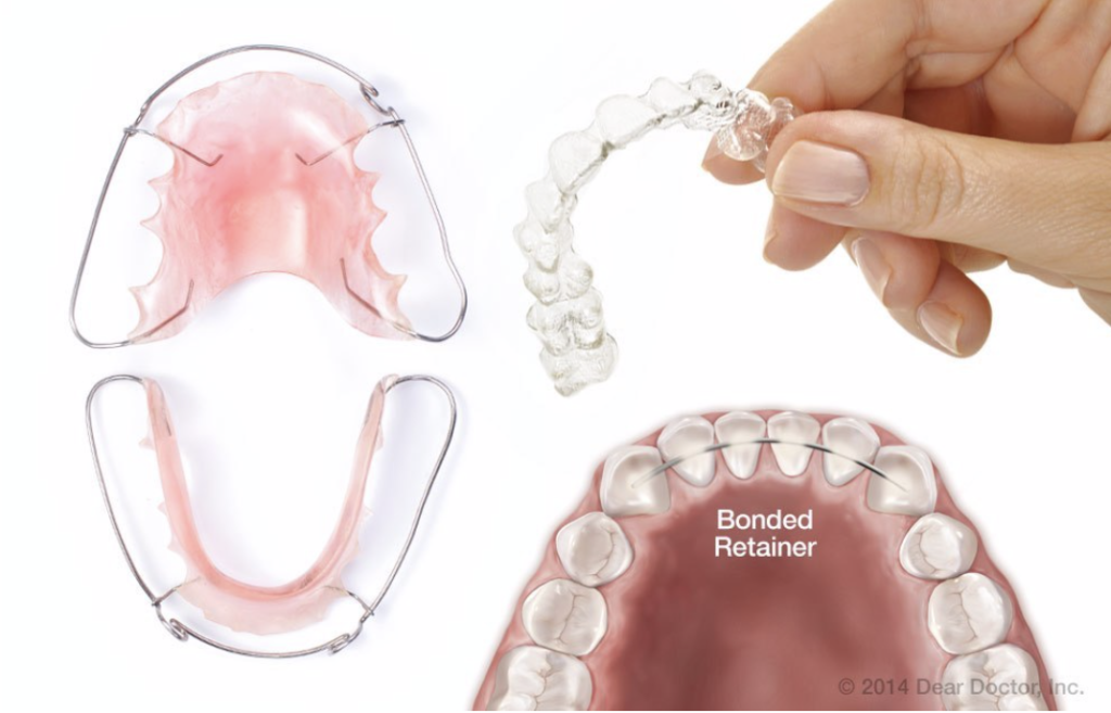 How To Properly Clean Orthodontic Retainers