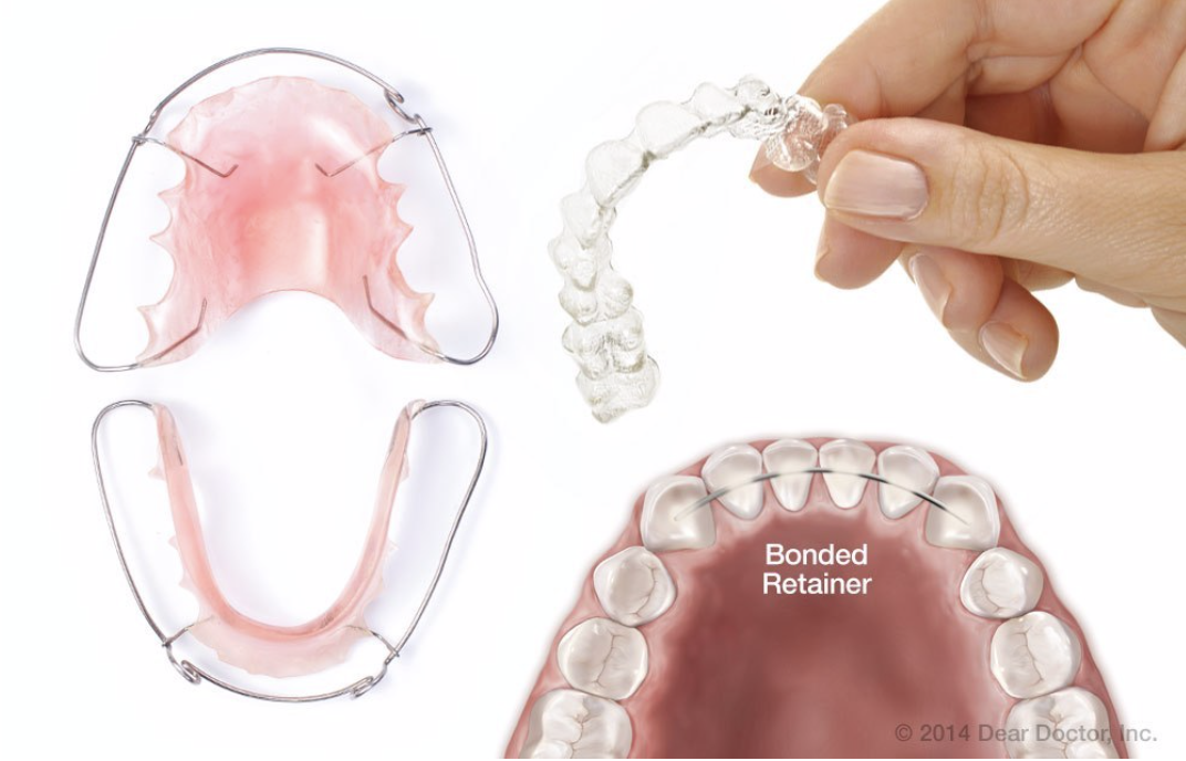 How to Properly Clean Orthodontic Retainers